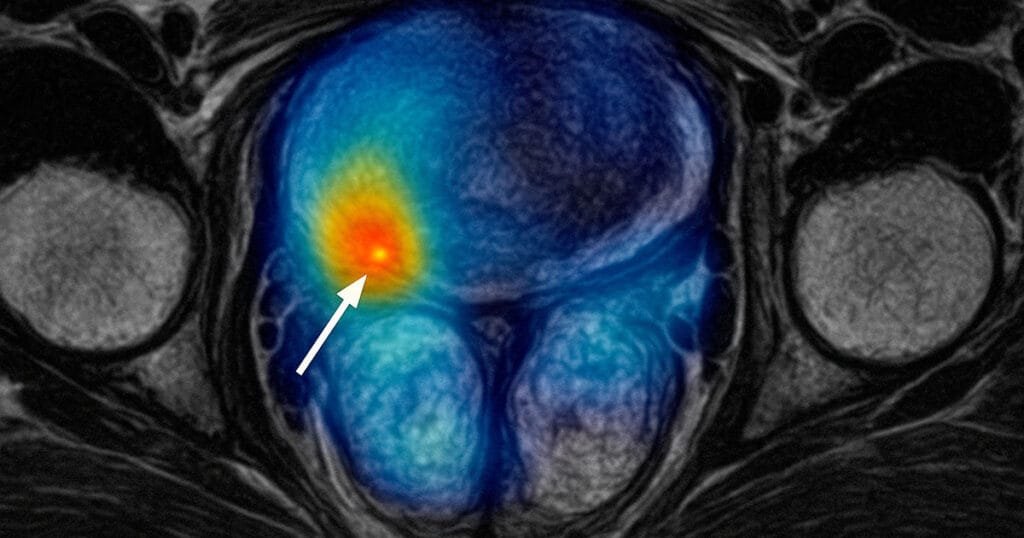 Medical scan with heat map overlay showing high activity areas. Arrow points to specific region analysed by Isambard AI supercomputer technology.